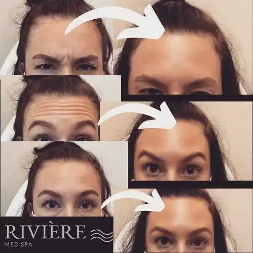 We don't stop 'till you get enough — Botox at Rivière Med Spa Portland delivers dramatic smoothing of forehead wrinkles with 
